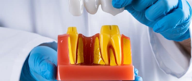 DentistInGlovesShowingDentalToothBridgeModel