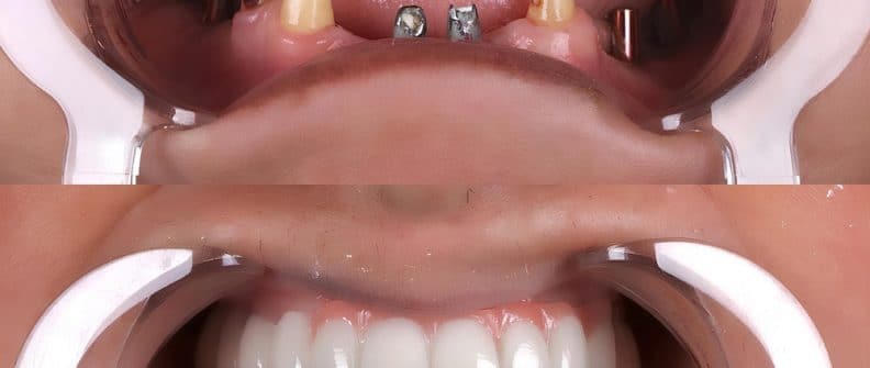 FullJawDentalProsthesisInPeopleWithNoTeethDental